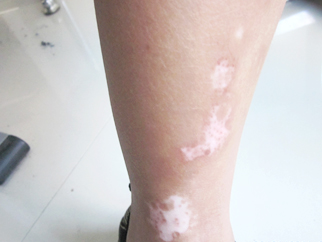 宋同學 12歲 右小腿白斑6年