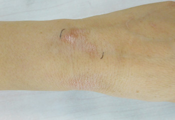 治療2個(gè)月后手腕白斑逐漸消退