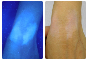 手腕白癜風3個月治好 特別感謝高霞主任