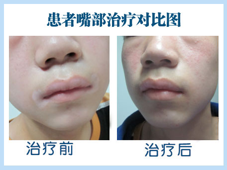 廊坊嘴部白癜風治療容易嗎