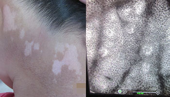 美國極速308nm準分子激光——治療白癜風的核心技術