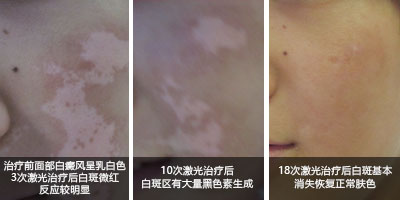 美國極速308nm準分子激光——治療白癜風的核心技術