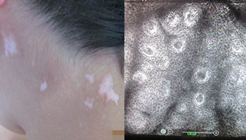 美國極速308nm準分子激光——治療白癜風的核心技術