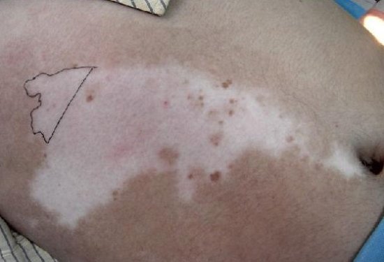 白癜風,治療,專科,醫(yī)院,滄州