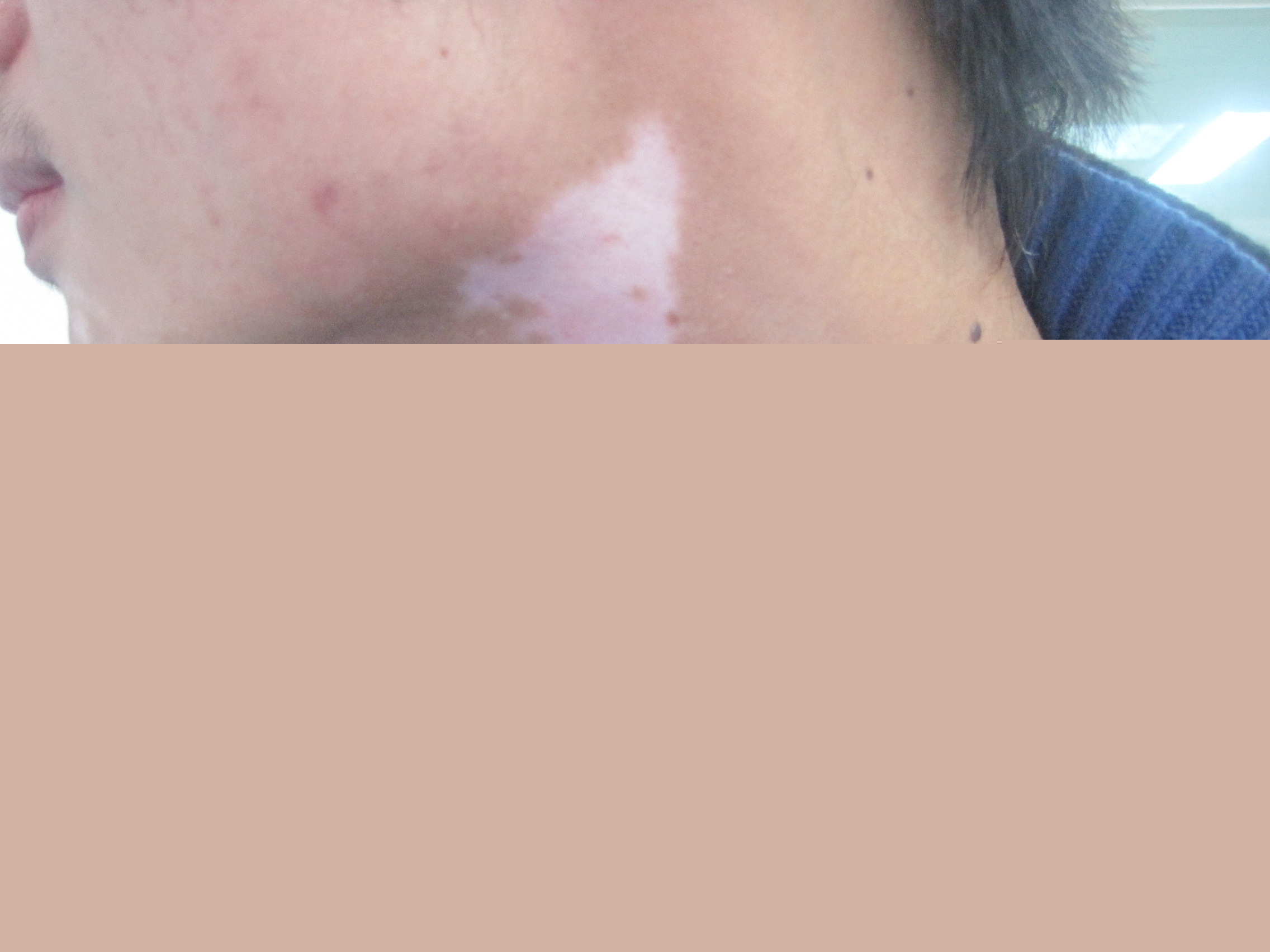 河北深澤縣有用308準分子激光治療白癜風的醫院嗎?