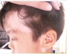 邯鄲廣平治療兒童白癜風比較好的醫院是哪個?