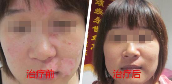 面部白斑，可怕的情場“攔路虎”