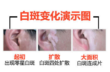 暑期白癜風專項普查