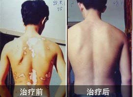 男性白癜風患者怎么治療更安全