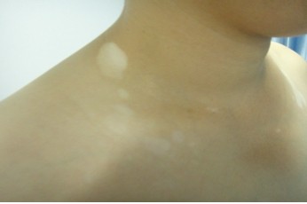 孕婦白癜風治療后復發(fā)怎么辦