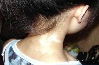 女性為什么也會得白癜風呢