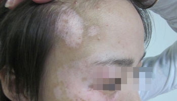 女性皮膚出現白癜風怎么辦