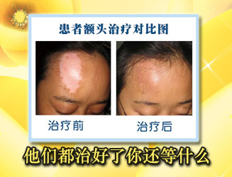 女性白癜風使用怎樣的治療方法