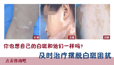青年面部白癜風(fēng)要怎么治療能行