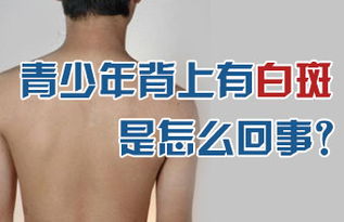 治療青少年白癜風發展期怎樣合適