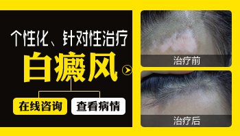 高中生全身長(zhǎng)白癜風(fēng)怎么治
