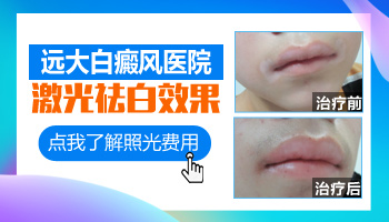 青少年后背白癜風(fēng)每個星期照一次激光效果好嗎