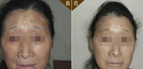 秦皇島治療白癜風多少錢