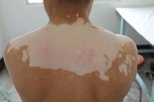 女性穩定期白癜風擴散的主要原因是什么?