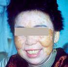 什么原因導致老年白癜風久治不愈?