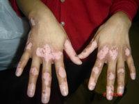 用308準分子治療白癜風發紅發癢正常嗎?