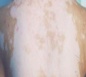 發病很多年的白癜風去藁城哪家醫院可以看好?