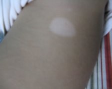 石家莊醫(yī)院能治好白癜風(fēng)早期嗎