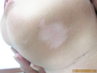 1年頸部白癜風在遠大治好