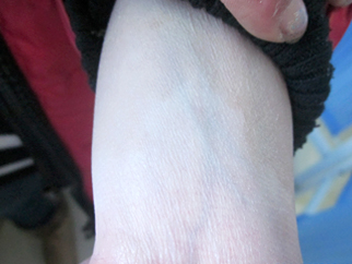 女性手臂白癜風案例