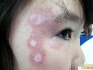 5年白癜風終于治好，父母感激涕零