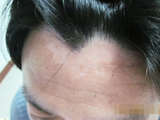 右側鬢角白斑6年多