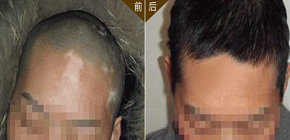 唐山白癜風醫院照光多少錢