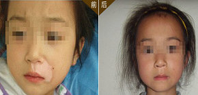 唐山導致兒童白癜風原因有哪些