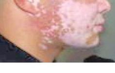 白癜風(fēng)的危害