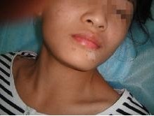 白癜風對女性患者帶來什么樣的危害