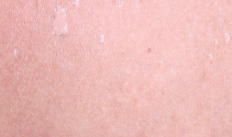 男性白癜風的危害是什么