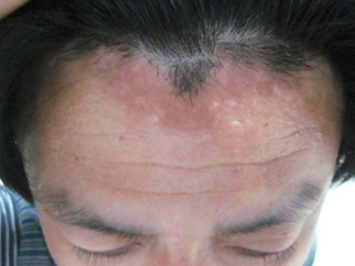 治療2個月-1.jpg