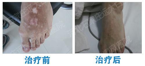 肢端型白癜風