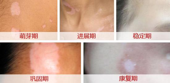 速來(lái)圍觀(guān)—“三看五測(cè)法”快速診斷白癜風(fēng)