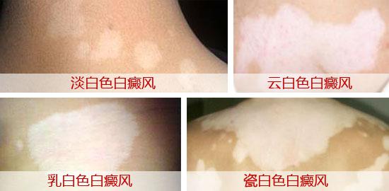 白癜風診斷