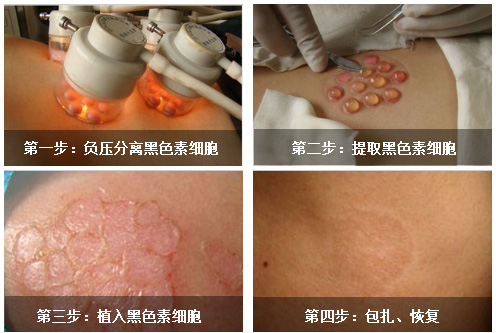 手術(shù)治療白癜風(fēng)需要提前做什么準(zhǔn)備嗎