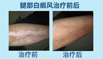 感念師恩 攜手告白——2019教師節(jié)白癜風(fēng)普查活動(dòng)