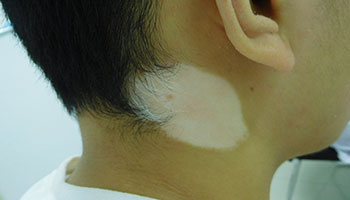 4.15白癜風(fēng)防治日暨白斑免費(fèi)普查活動(dòng)開啟