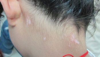 4.15白癜風(fēng)防治日暨白斑免費(fèi)普查活動(dòng)開啟