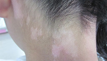 4.15白癜風(fēng)防治日暨白斑免費(fèi)普查活動(dòng)開啟