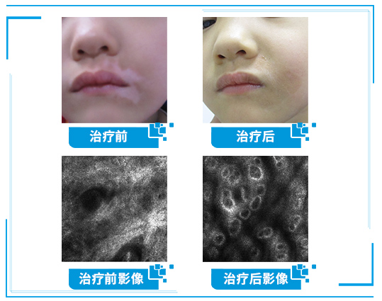 6.25世界白癜風日—“拒絕歧視，共抗白斑”普查援助活動