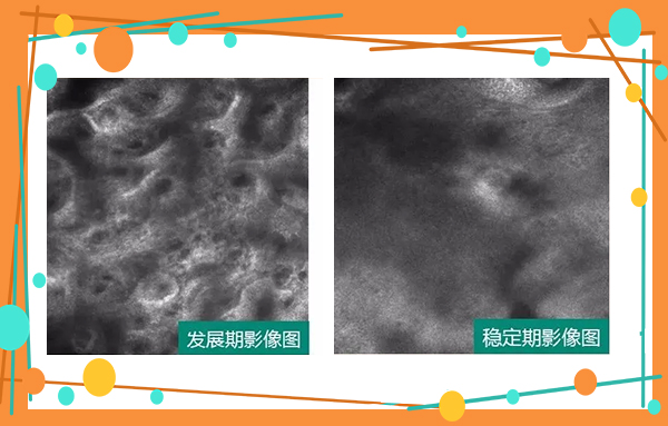 6.25世界白癜風日—“拒絕歧視，共抗白斑”普查援助活動