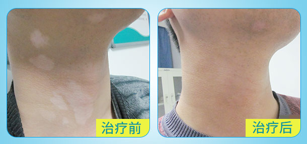 新年送祝福！元旦白癜風診療援助活動開啟！