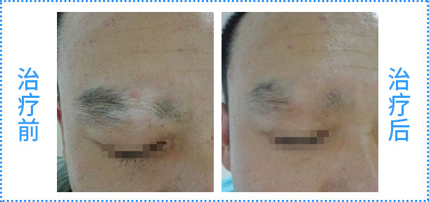 脾多肽注射液聯合308nm準分子激光治療白癜風臨床療效評估