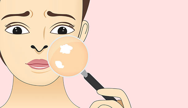 暑期白斑0元公益普查暨京冀白癜風醫師特別會診活動